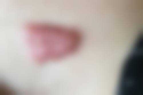 三、疤痕变黑、留疤的真正“元凶”是什么？