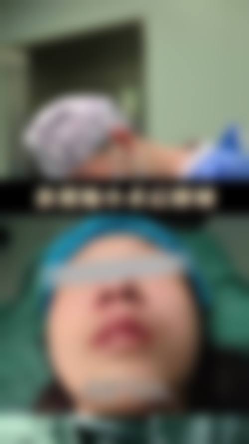 六、ADM填充鼻基底风险或注意事项