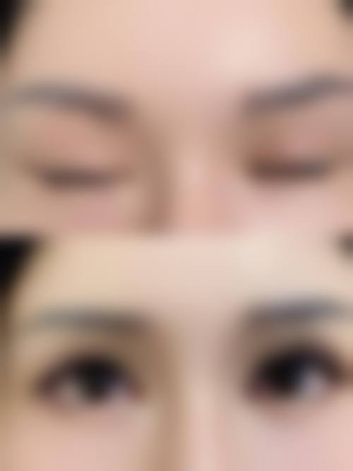 十、李正根医生相关科普内容推荐——脂肪填充失败修复