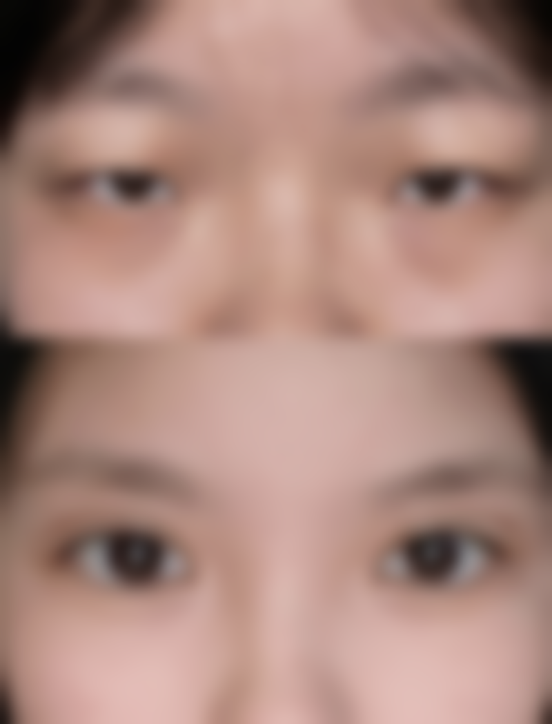 {做完双眼皮全切手术注意事项有哪些？术后护理+忌口清单全攻略，医生亲授消肿秘籍！