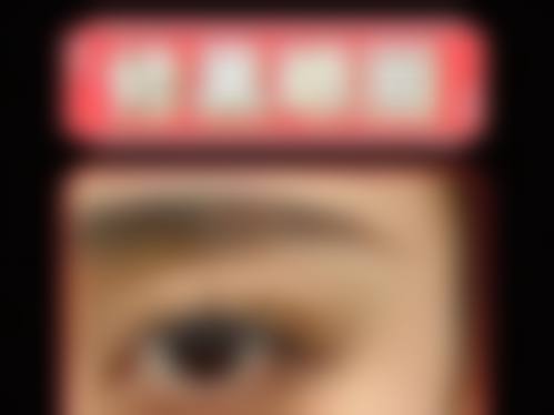 三、如何判断双眼皮两个月肉条是否正常