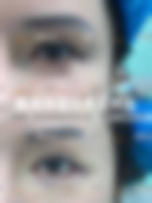 七、黑眼圈和眼袋化妆的风险与后遗症