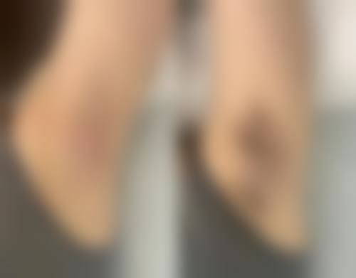 2、激光治疗银屑病核心技术优势