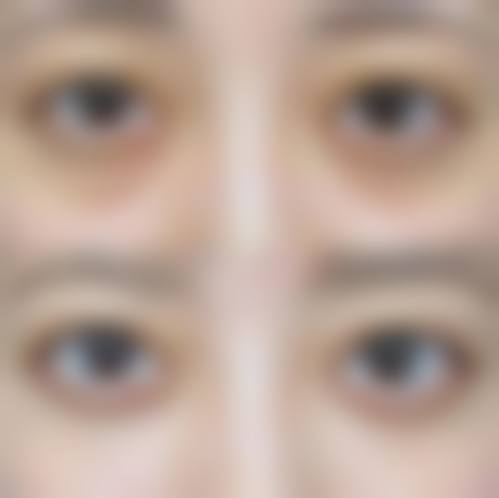 {自体脂肪泪沟填充手术有后遗症吗？有！脂肪存活率不足30%、凹凸不平、肿胀期超2周等5大风险要警惕