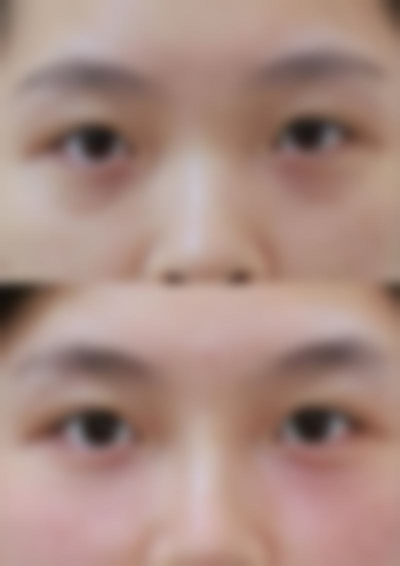 四、激光除皱有什么副作用吗？全方面了解风险