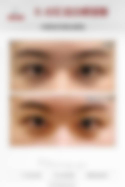 四、全切双眼皮割太深能修复吗