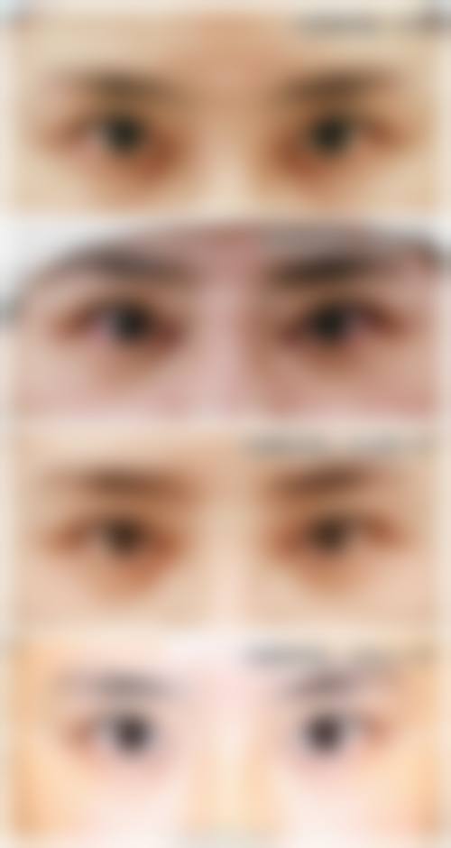 九、适合进行全切双眼皮修复的人群