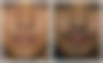 {种植完头发多久能喝酒？三甲医生建议：术后1周禁饮，1-3个月可适度，抽烟需戒1个月