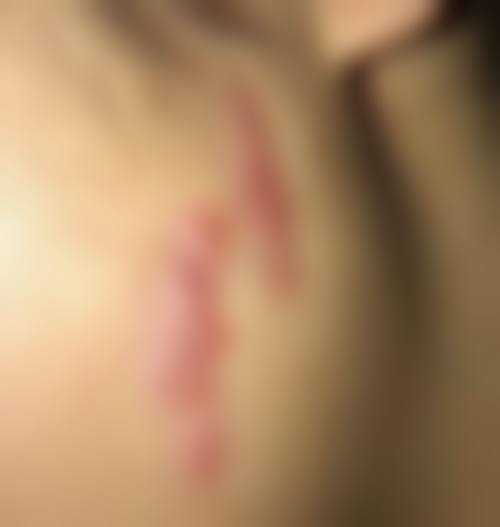 八、疤痕疙瘩治疗的常见误区