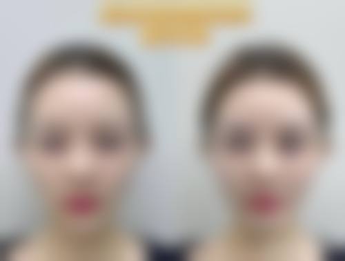 五、适合在双眼皮术后吃炸鸡腿的人群