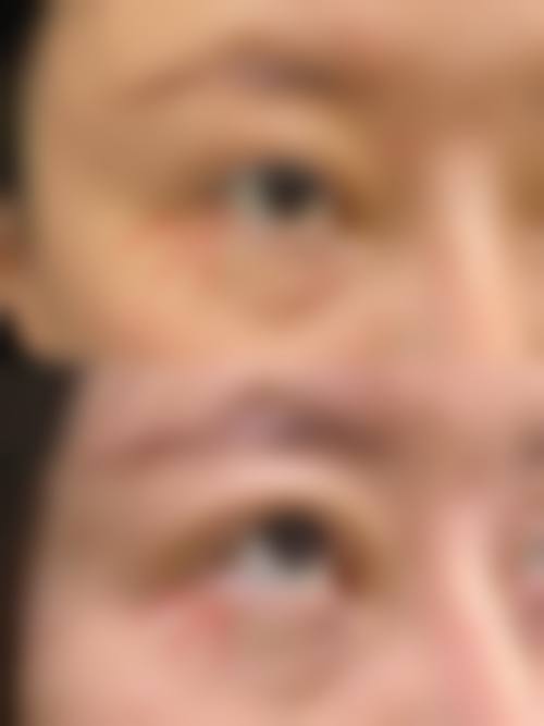 三、视觉放大的关键之二：矫正上睑与眼角问题，做全切双眼皮眼睛会变大吗？