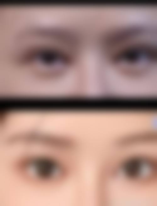 {割完双眼皮眨眼睛疼怎么回事？术后护理不当or感染？2026最新消肿止痛指南