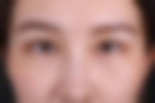 {全切双眼皮会显得眼睛大吗？医生揭秘：视觉放大3大关键+术后恢复真实案例对比！