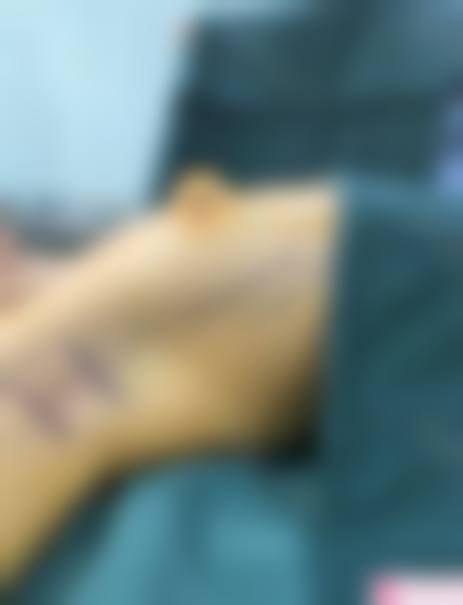 三、假体隆胸术后详细睡姿指南