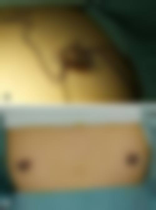 四、假体隆胸成效如何