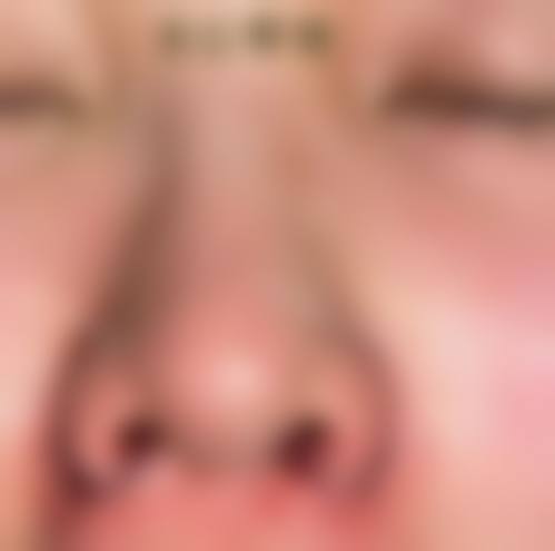 七、达拉斯隆鼻有哪些危害和缺点