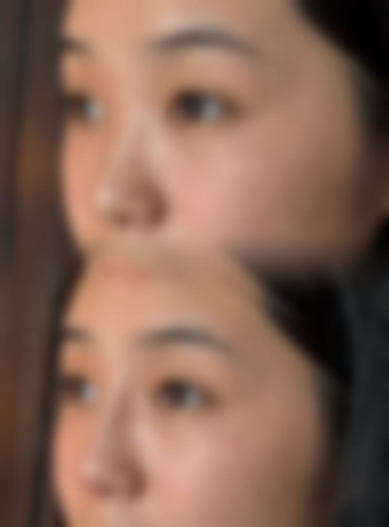 三、达拉斯隆鼻用的异体材料有哪些优势和风险