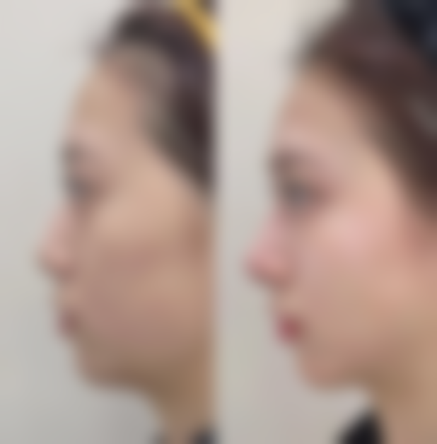 {达拉斯隆鼻用什么材料做的？揭秘3种自体软骨+硅胶膨体选择，2026南宁华美2.7w起