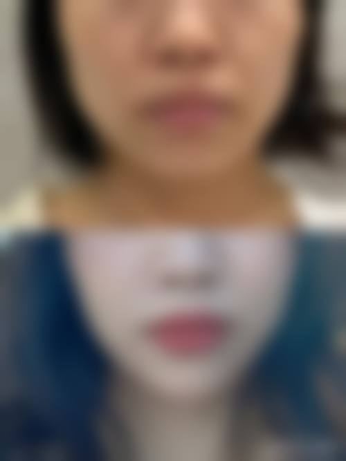 六、骨干医生总结：正确看待打瘦脸针的副作用