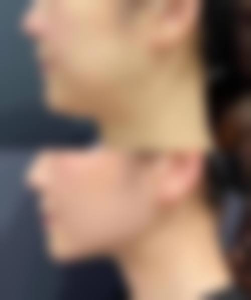 {打瘦脸针的副作用有哪些？三甲医生揭秘：面部僵硬、凹陷等5大风险，安全注射必看！