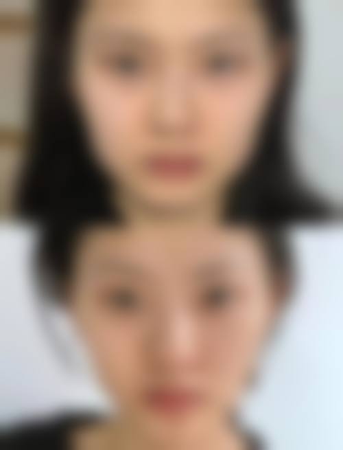 三、北京医院曝光打瘦脸针凹陷风险