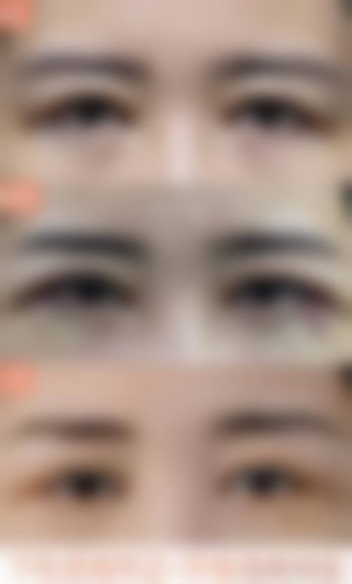 失眠引起的眼袋怎样才能修复好？