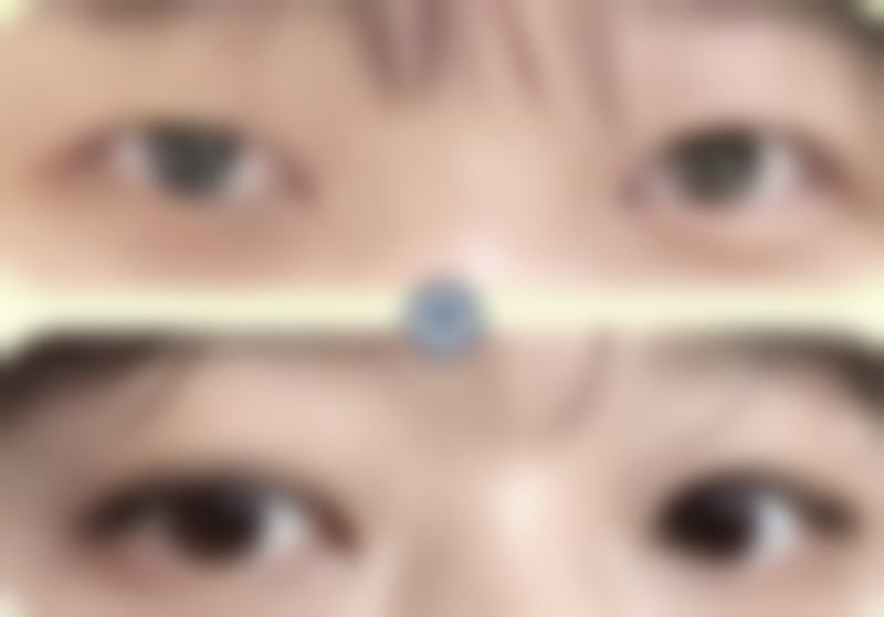 失眠导致的黑眼圈能去掉吗？