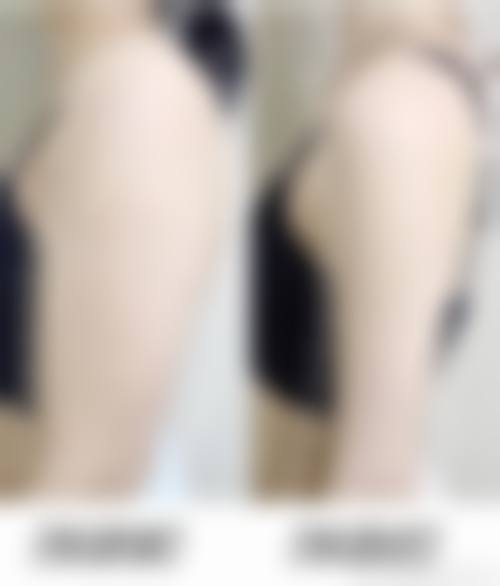 手臂抽脂安心吗 / 有哪些风险