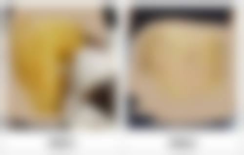 八、小切口拉皮手术医院医生如何选择