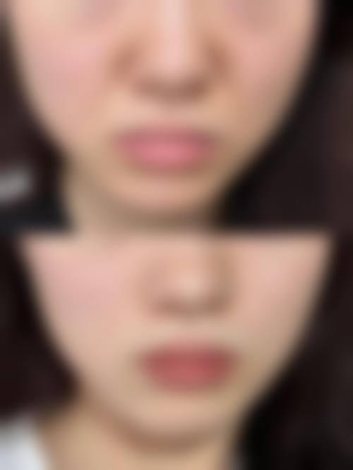 五、小切口拉皮手术安心吗