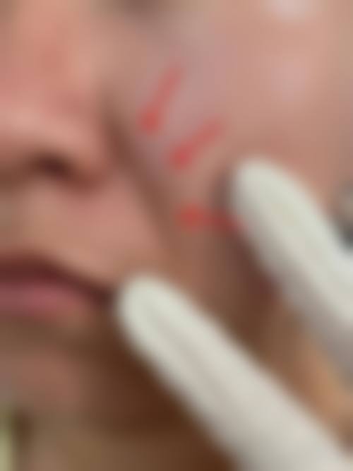 七、怎么判断自己是否适合小切口拉皮手术