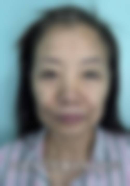 二、小切口拉皮手术3万起做