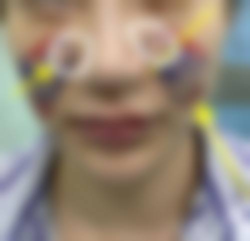 四、小切口拉皮手术成效如何