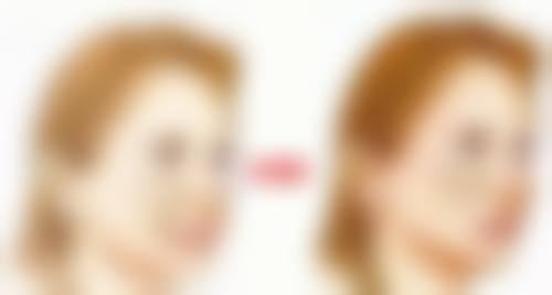 六、美容院打除皱针，这些安心注意事项必看！