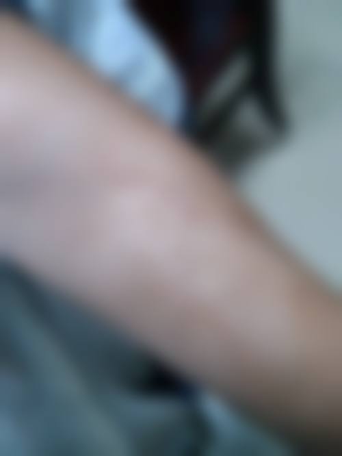 德州韩的式医疗美容诊所精细化双眼皮手术技术优势