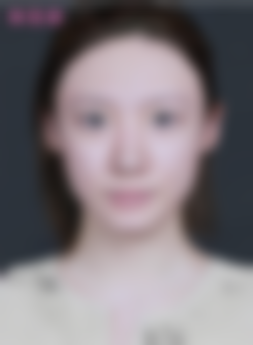 {北京面部吸脂多少钱？米兰柏羽丽都牟严儒医生单部位吸脂7200元起，双下巴、下颌缘精雕，术后紧致无痕！