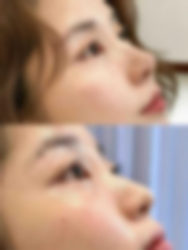 {美容院的除皱针打的是什么？揭秘肉毒素与玻尿酸的真实成分，安全除皱必看！