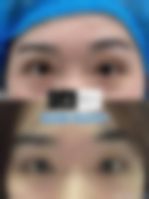 眶隔脂肪释放术有哪些专属术后注意事项？