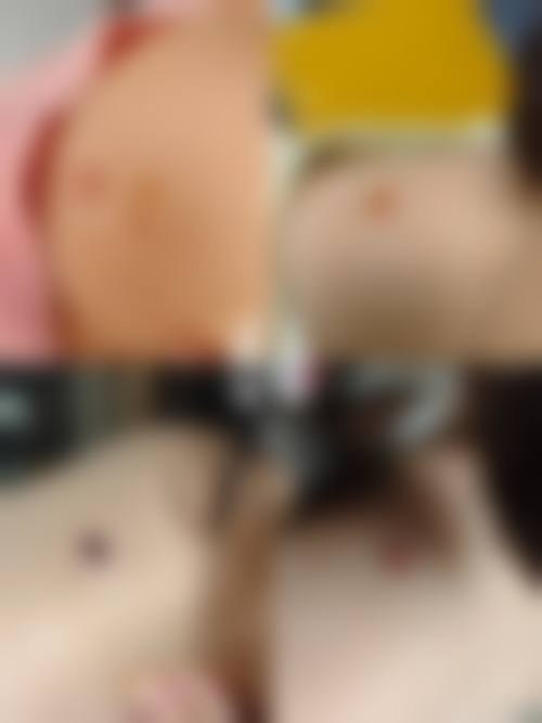 三、药物治疗祛疤