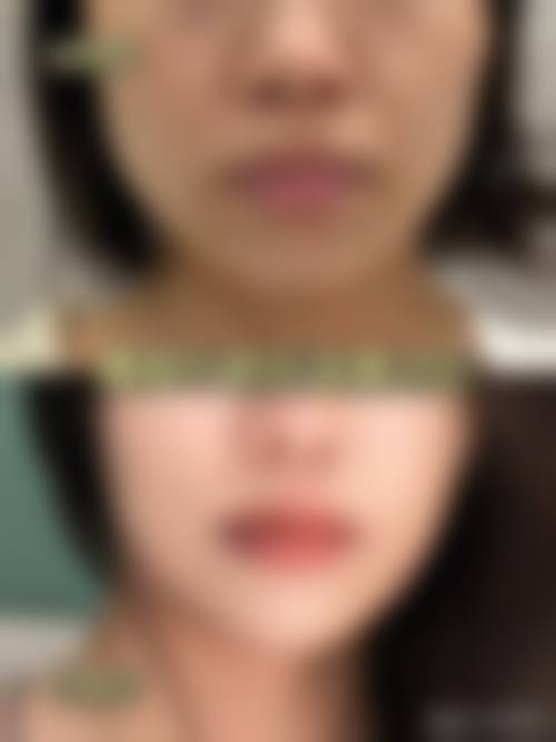 五、术后1周修复记录：每天都有小惊喜