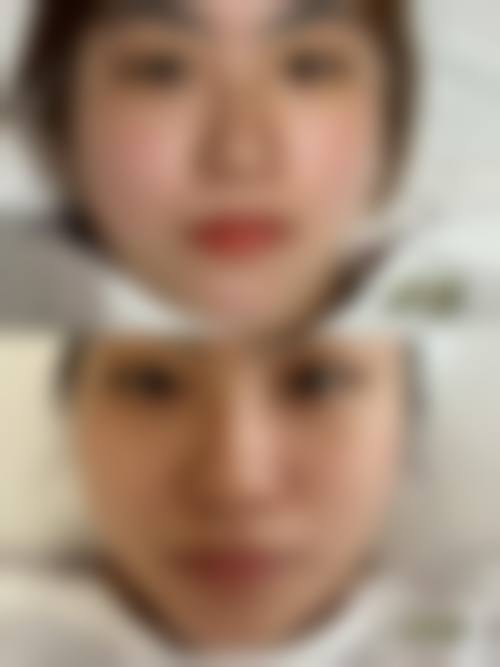 胖的时候打瘦脸针再减肥可以吗？