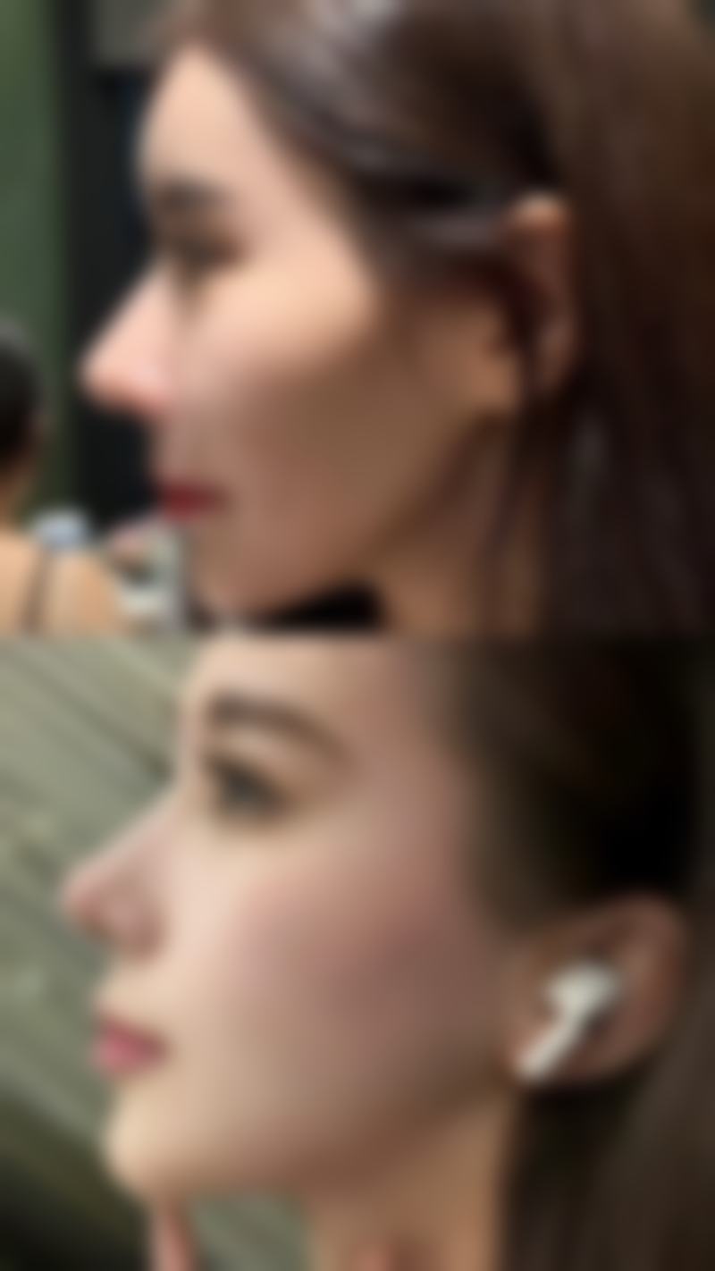五、隆鼻假体取出后能否修复到原来的样子