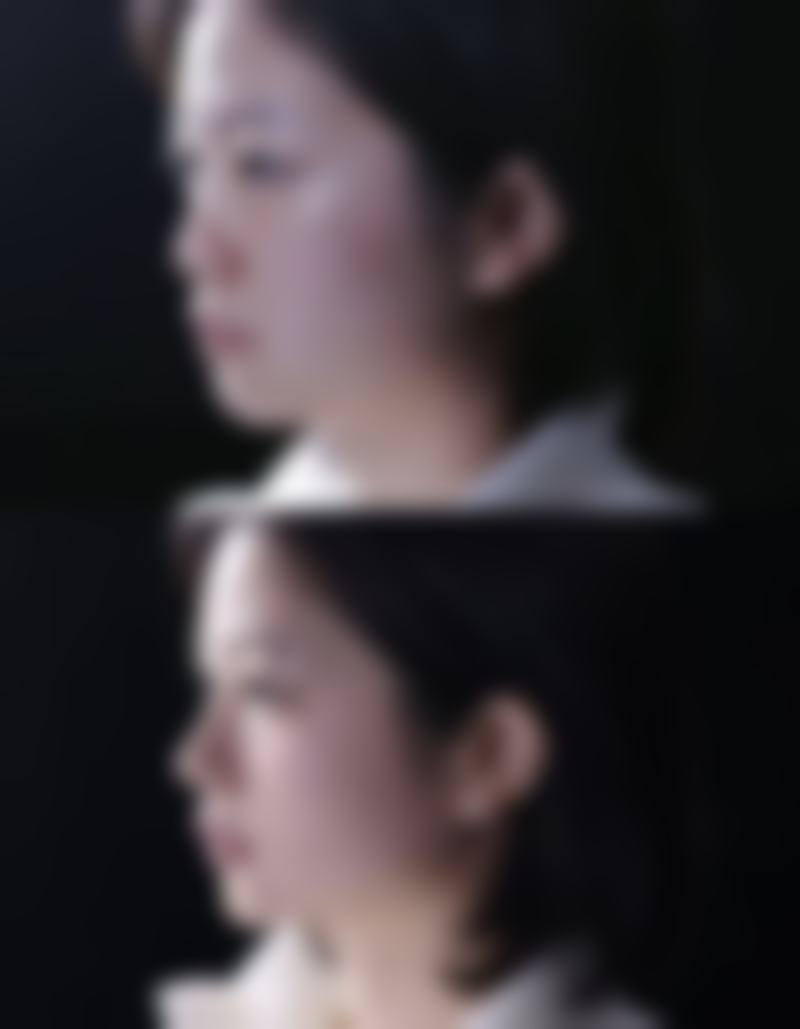 {隆鼻假体取出后会影响鼻子形状吗？真相是【李海东】医生3个月恢复数据：因组织回缩鼻梁会暂时显宽，但并非毁容性挛缩。