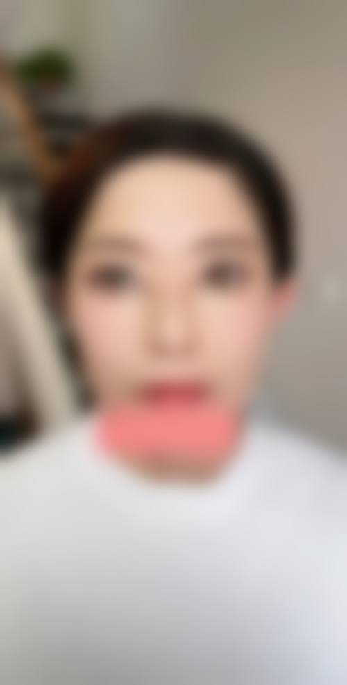 {扇形可以改平行双眼皮吗？2026实测【关键点】看扇形双眼皮和平行双眼皮的区别（选错显凶就晚了）
