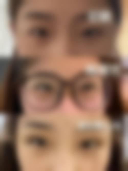 三、扇形和平行双眼皮的区别有哪些