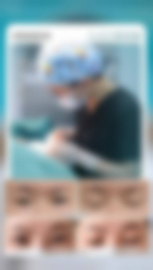 二、做了双眼皮后眼睛模糊了怎么回事