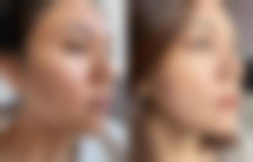 三、点痣疤痕修复的其他方法有哪些