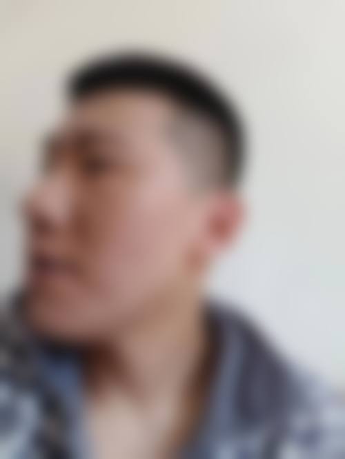二、点阵激光修复点痣疤痕成效如何