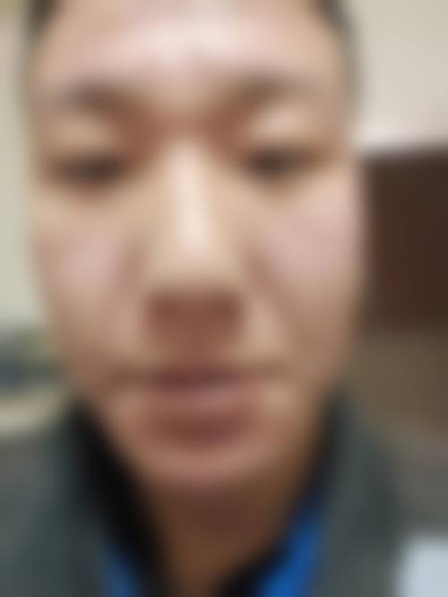 {脸上的点痣疤痕怎么办？2026点阵激光3 - 5次修复，找【张医生】在线对比案例！ 