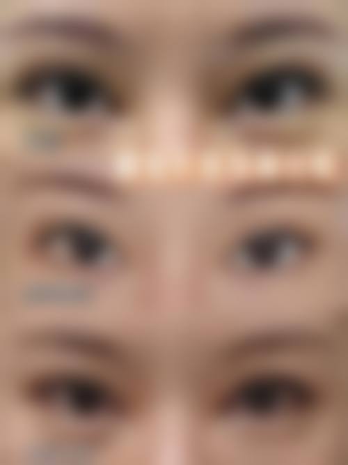 三、去皮过量需手术